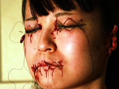All holes sutured