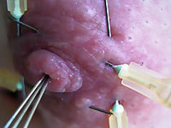Needles in nipples